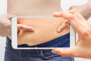 Strie: odstranění Acoustic Wave Treatment