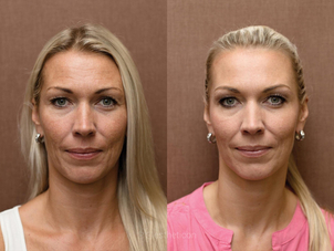 Výsledek chemického peelingu