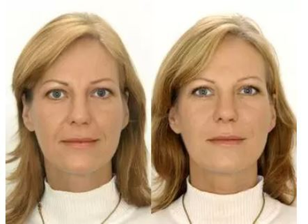 Fotky před a po omlazení obličeje mezoterapií. (foto: soukromý archiv kliniky)
