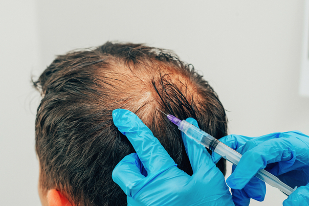 Jak se provádí léčba vypadávání vlasů pomocí plazmaterapie?
