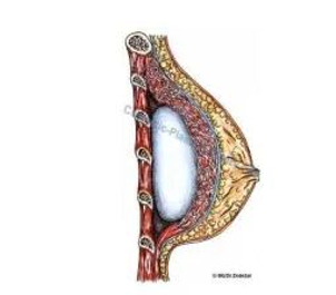 Prsní implantát pod svalem (foto: soukromý archiv lékaře)