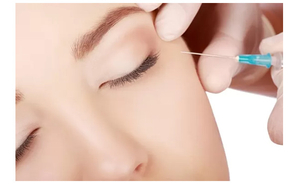 Kyselina hyaluronová se aplikuje injekcemi nebo kanylou.