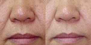 Jak probíhá zotavení po mikrodermabrazi?