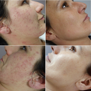 Foto před a po odstranění jizev po akné