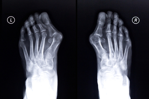 Co je operace Hallux valgus?