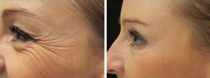 Fotky před a po aplikaci botulotoxinu
