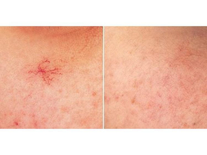 Laserové odstranění rozšířených žilek