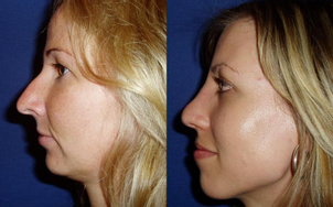 Před/po operace nosa