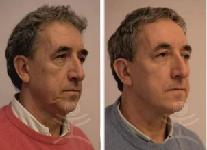 Fotky před a po aplikaci zlatých nití. (foto: soukromý archiv kliniky)