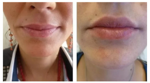 Zvětšení rtů injekčními výplěmi na bázi kyseliny hyaluronové. Foto před a po ošetření kyselinou hyaluronovou (foto: soukromý archiv kliniky)
