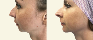 Výplně vlastním tukem v obličeji (klinika AESTHEVITA)