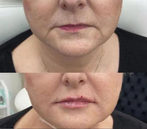 Kyselina hyaluronová