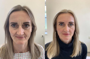 kyselina hyaluronová