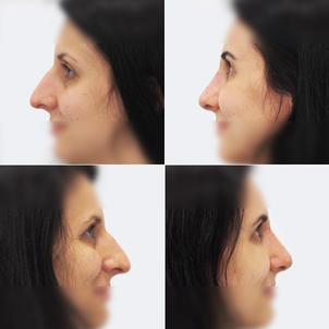 Plastická operace nosu (rhinoplastika)