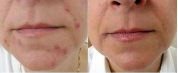 Foto před a po léčbě akné.
