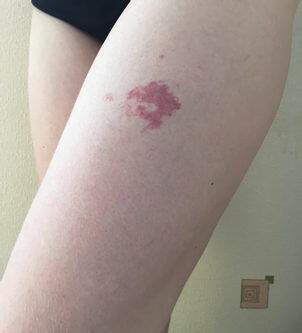 Jak zjistím, zda jsem vhodný kandidát na léčbu hemangiomů?