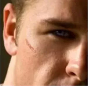 kandidátem pro odstranění jizev laserem