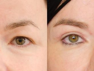 Výsledek laserové blefaroplastiky