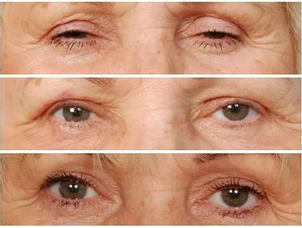 Žena, 68 let, střední ptóza bilat. Foto: Před operací, 1 týden a 3 měsíce po operaci. (shora)