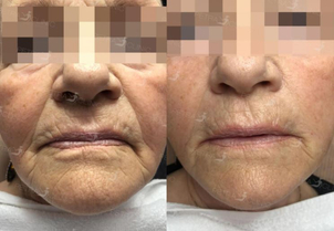 Kyselina hyaluronová