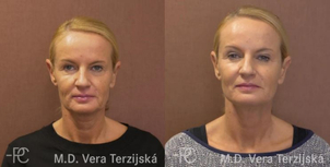 Kyselina hyaluronová