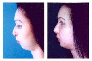 Úprava úhlu dolní čelisti