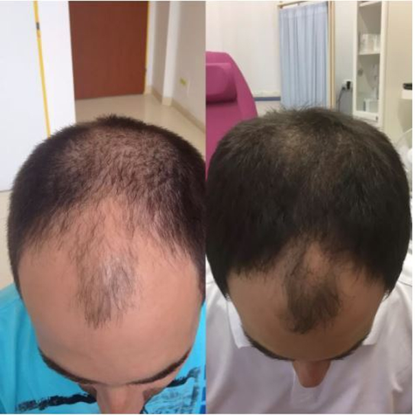 Léčba vypadávání vlasů (alopecie).