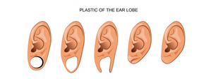 Pro koho je korekce ušních dírek a lalůčků vhodná