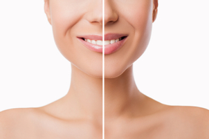 Kyselina hyaluronová