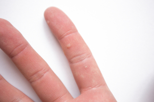 Jak se provádí léčba bradavic?