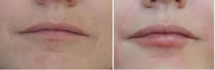 Zvětšení rtů kyselinou hyaluronovou