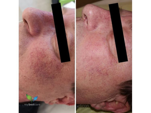 Laserové odstranění rozšířených žilek