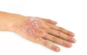 Lupénka na hřbetu ruky.