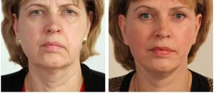 Facelift pomocí 3D nití. Fotky před a po zákroku (foto: soukromý archiv kliniky)