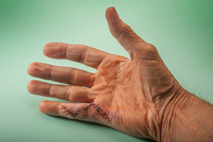 Výsledky chirurgie ruky