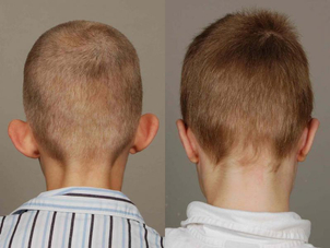 Před/po: otoplastika