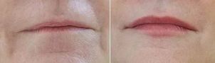 Zvětšení rtů kyselinou hyaluronovou