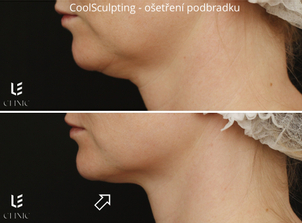 Výsledek kryolipolýzy