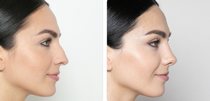Před/po rhinoplastika