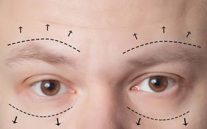 Operace horních víček