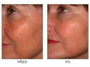 Výsledek chemického peelingu