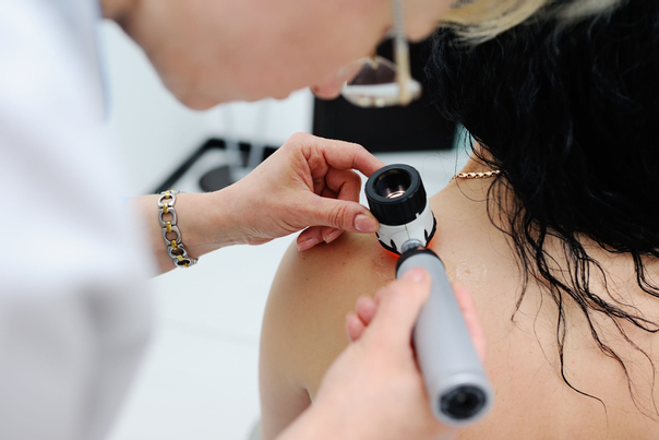 Vyšetření znaménka dermatoskopem je důležitou prevencí a možností včas odhalit zhoubný melanom
