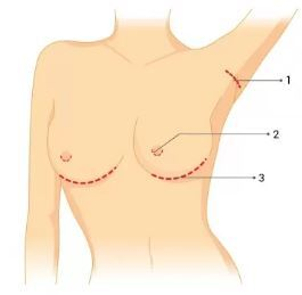 Umístění řezu: 1 - v podpaží, 2 - přes prsní dvorce, 3 - v podprsní rýze (ilustrační foto)
