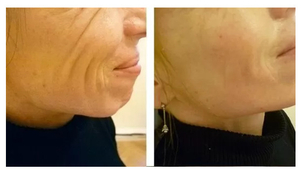 Výplně na bázi kyseliny hyaluronové. Fotky před a po aplikování kyseliny hyaluronové. Výplně v tomto případě řeší a odstraňují vrásky na tváři. (foto: soukromý archiv kliniky)