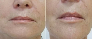 Výplň rtů kyselinou hyaluronovou