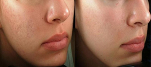 radiofrekvenční ošetření