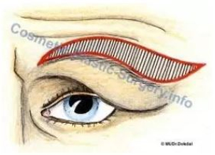 Nákres předpokládaného odstranění kůže