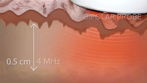 Při radiofrekvenčním omlazení se pokožka hloubkově stimuluje a prohřívá (foto: arhiv ShapeUp!)