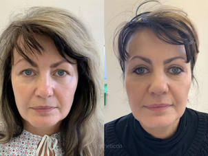 Výsledek laserové blefaroplastiky