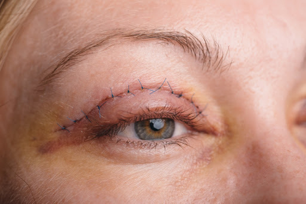 operace očních víček
